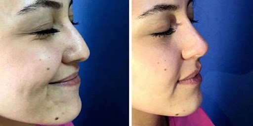 Burun Estetiği  Hakkında  En Çok bilinen 11 Yanlış Bilgi 9