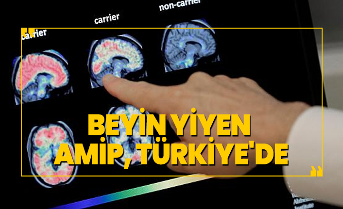 Beyin yiyen Amip, Türkiye'de