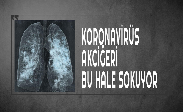 Covid-19 akciğerleri bu hale sokuyor