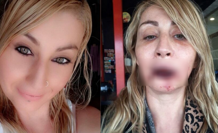 Estetik uğruna dudağı bu hale geldi!