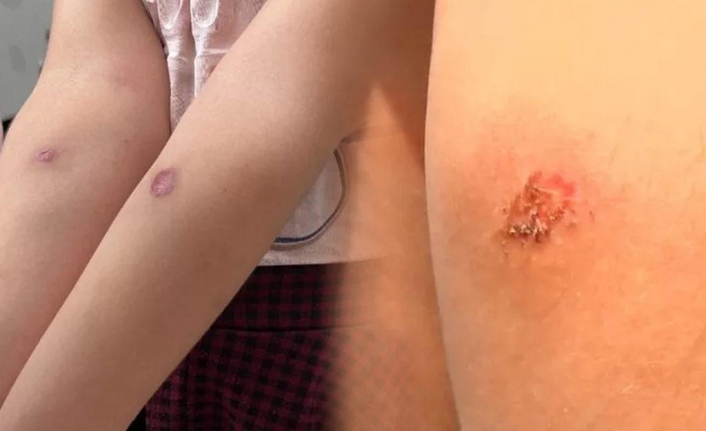 İstanbul'da en çok bu ilçelerde görüldü: Isırığında 3 ölümcül hastalık var!