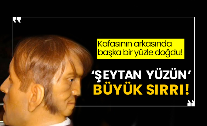 Kafasının arkasında başka bir yüzle doğdu! ‘Şeytan yüzün’ büyük sırrı!