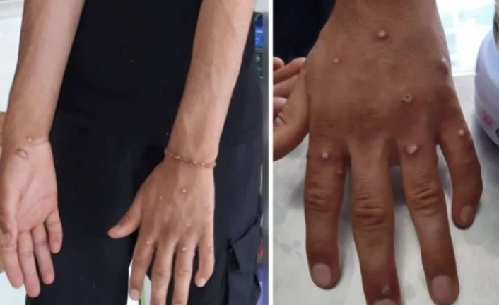 Biri bitmeden diğeri başlıyor! Sultangazi'de 'maymun çiçeği' şüphesi alarma geçirdi