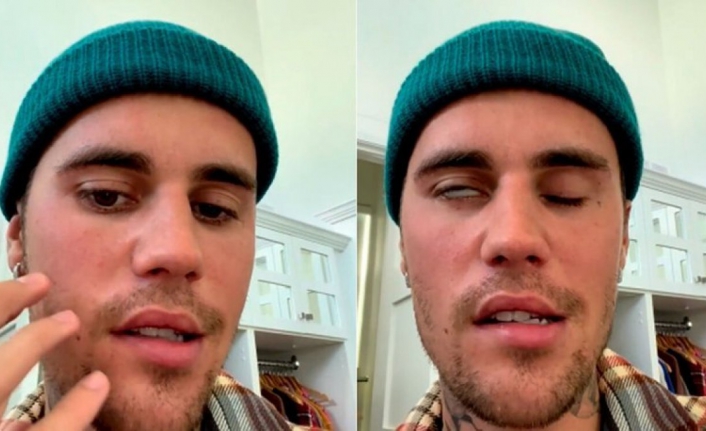 Justin Bieber'in hastalığı: Ramsay Hunt sendromu nedir