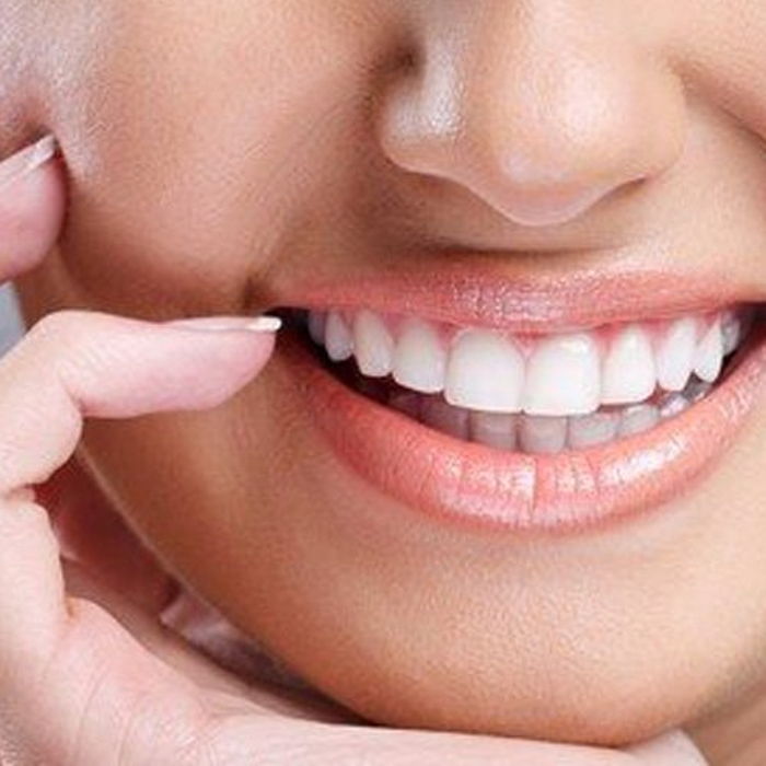 Yaprak Porselen (Lamina) nedir?