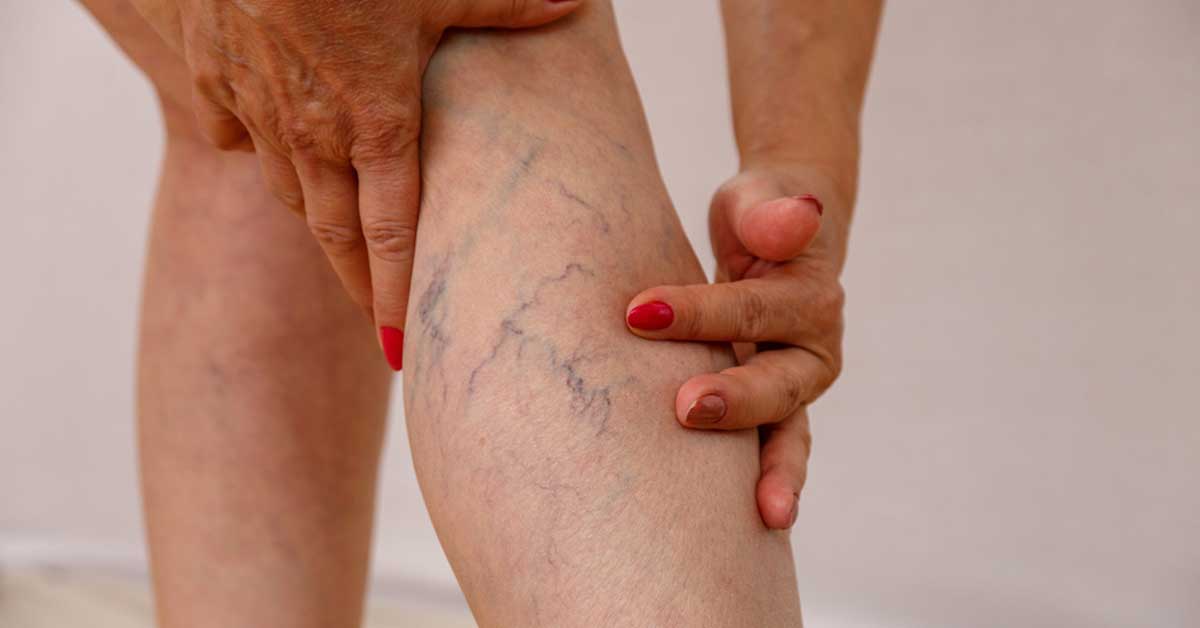 Varis Nedir? Belirti ve Tedavi Yöntemleri Nelerdir?