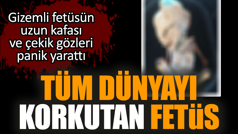 Tüm dünyayı korkutan gizemli fetüs!