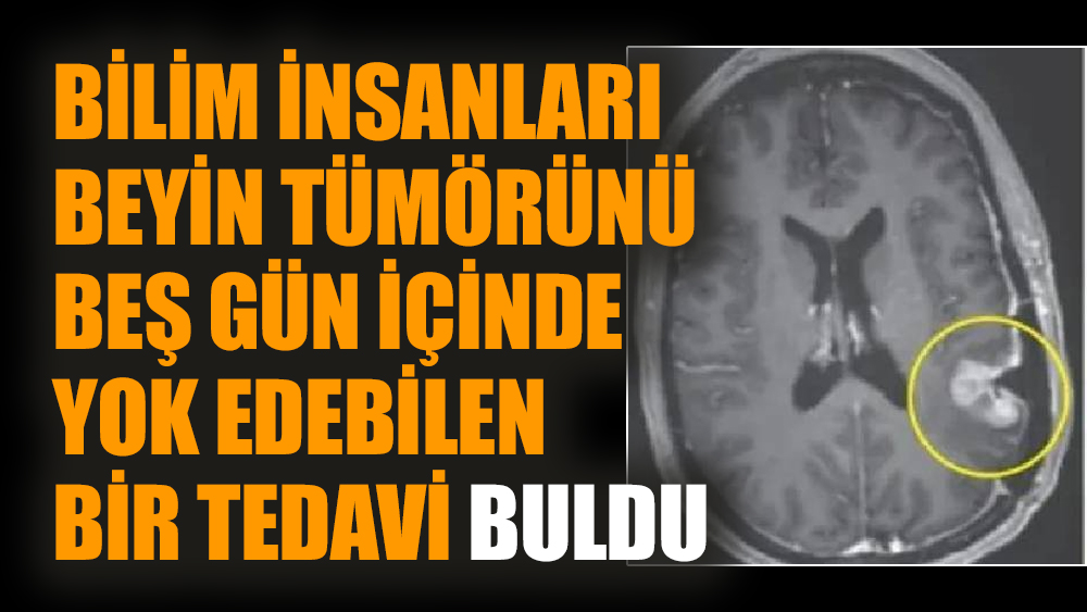 Bilim insanları beyin tümörünü beş gün içinde yok edebilen bir tedavi buldu