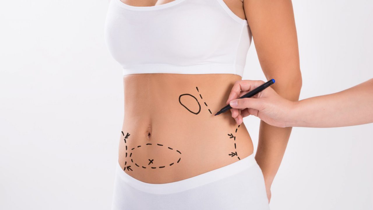 Bölgesel Yağlardan Kurtulma Formülü: Liposuction