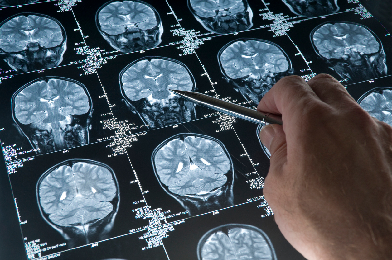 Sırt üstü yatmak ve burun karıştırmak Alzheimer’ı tetikleyebilir
