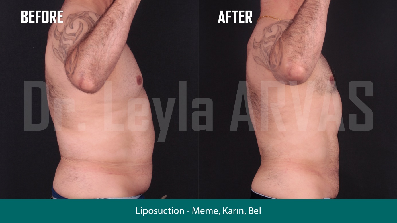 Vaser Liposuction ile Vücut Hatlarınızı Yeniden Keşfedin