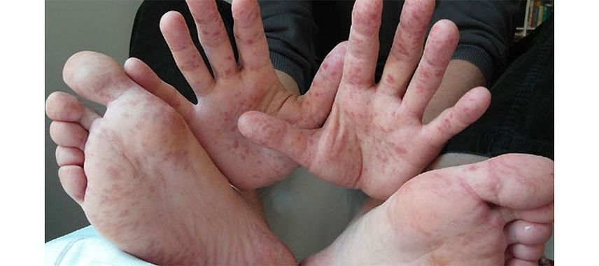 Okullarda El, Ayak ve Ağız Hastalığı Tehlikesi