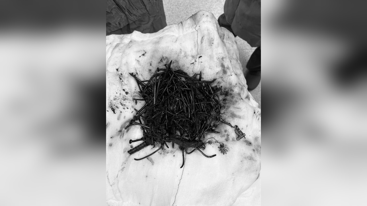 Zihinsel Engelli Kadının Midesinden 1 Kilogram Metal Cisim Çıktı