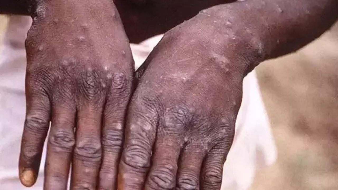 Sierra Leone'de Maymun Çiçeği Nedeniyle Acil Durum İlanı