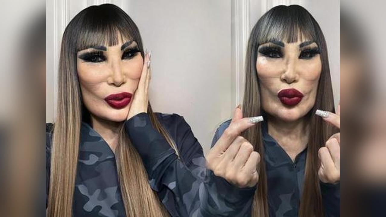 Lyn May'in Yüz Estetiği Değişimi Dikkat Çekti