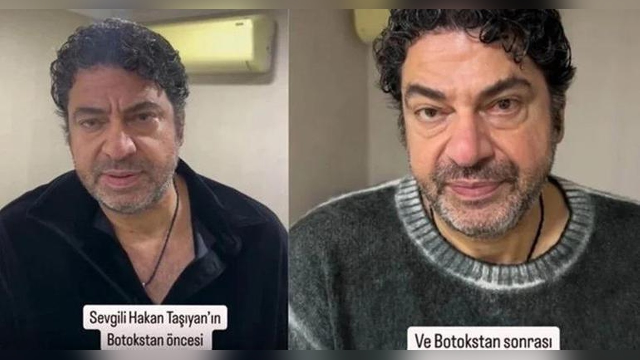 Hakan Taşıyan, Estetik Ameliyatla Yeniden Doğdu