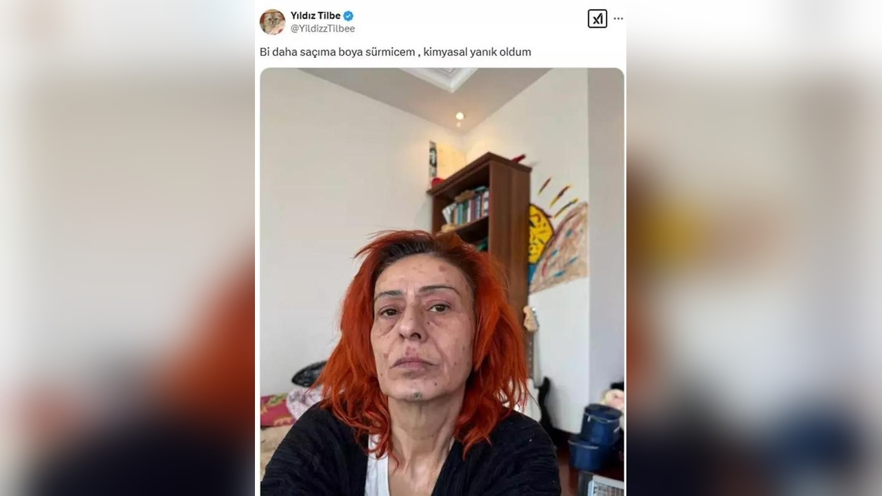 Yıldız Tilbe, Yüzündeki Yanık İzlerini ve Yaşadığı Süreci Paylaştı