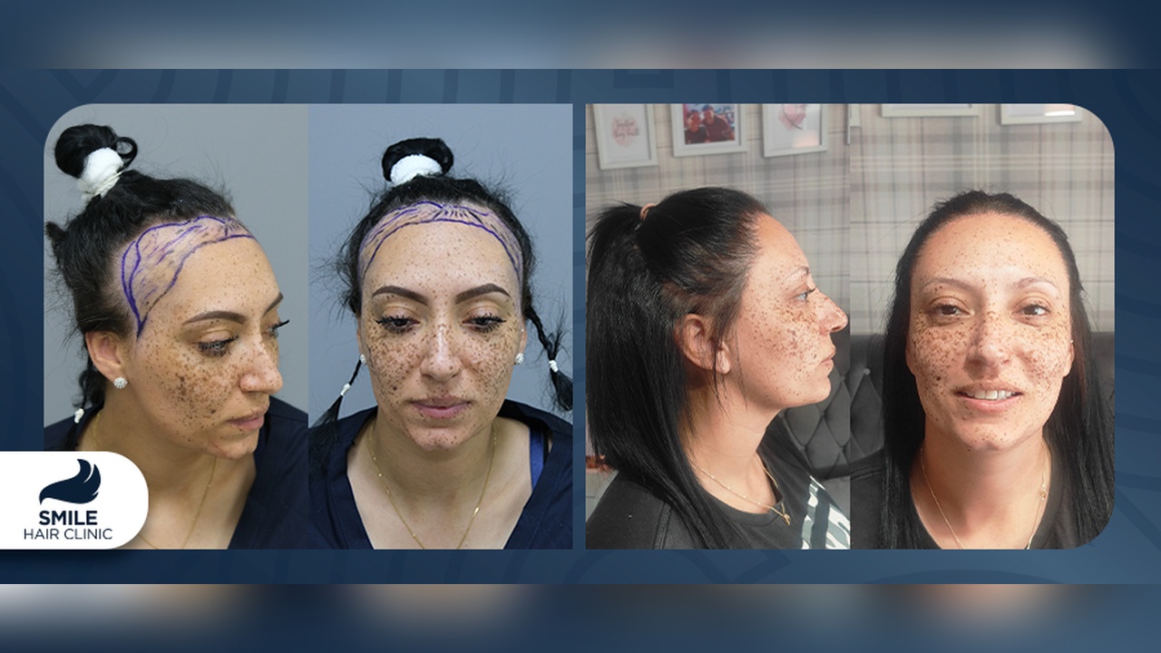 Kadınlar için Kişiye Özel Saç Ekimi Planlaması