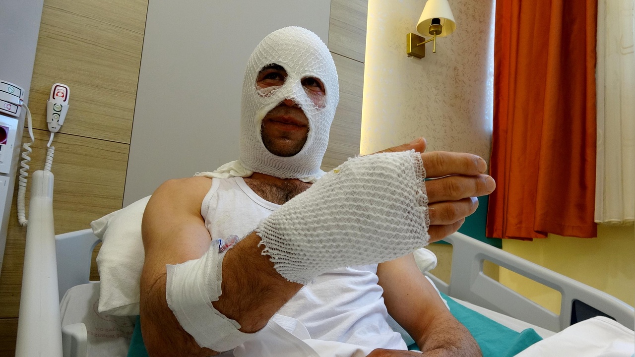 Sprey Boya Kutusunun Patlaması Nişanlıyı Hastaneye Kaldırdı