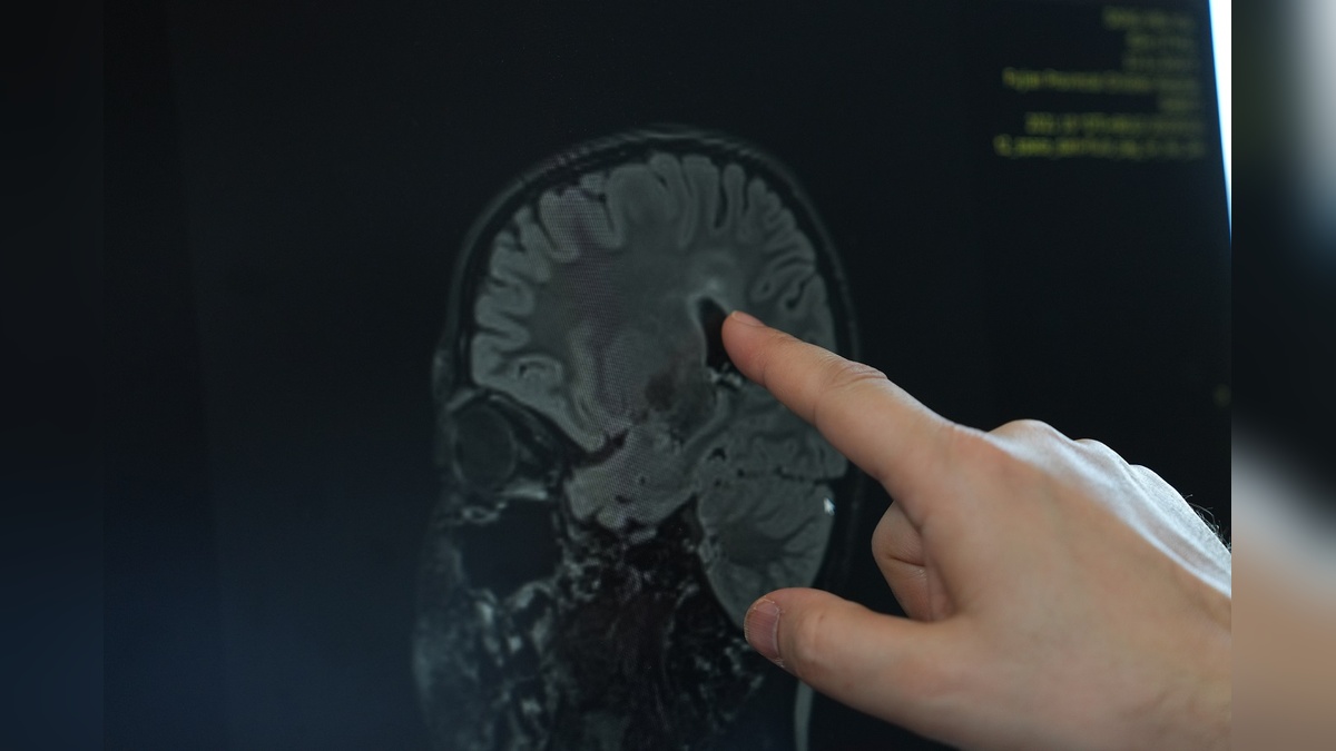 Serebral Palsi Tedavisinde Yeni Cerrahi Yöntem: Yaşam Kalitesi Dönüşüyor
