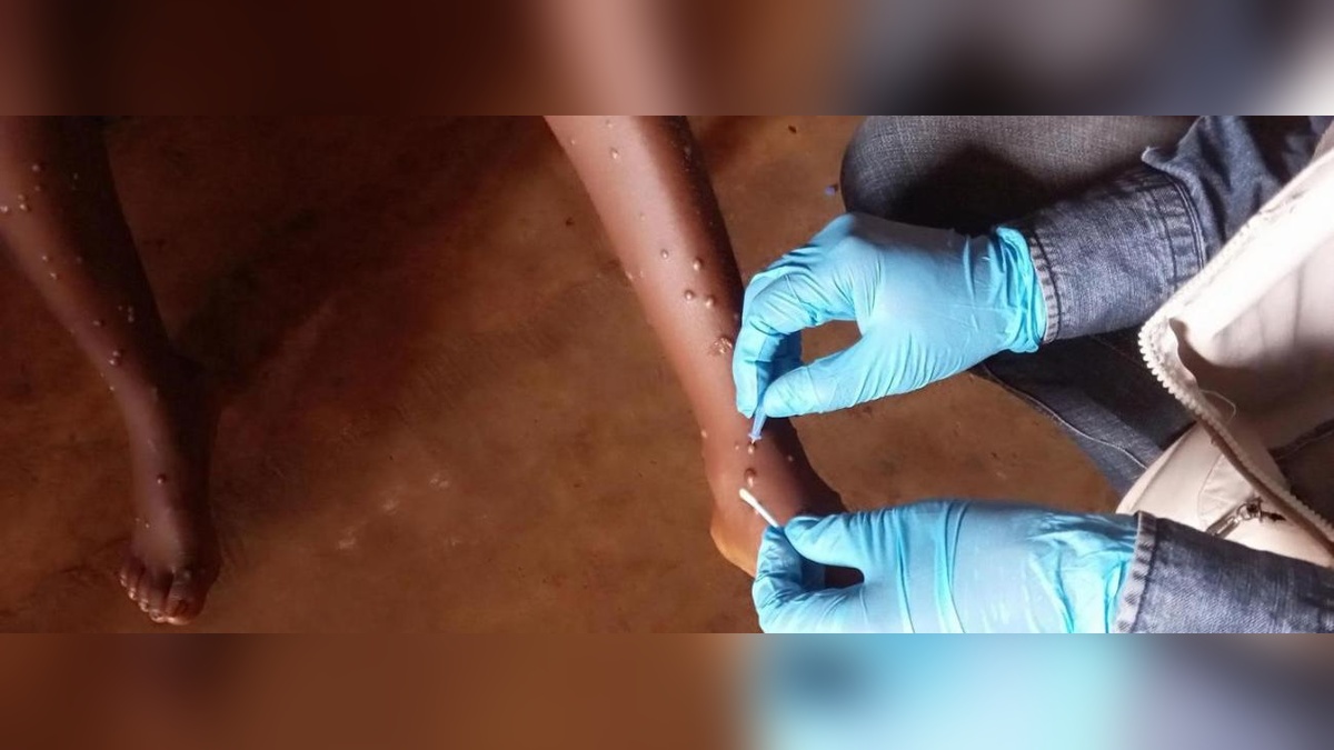 Gana'da mpox vakaları 302'ye yükseldi