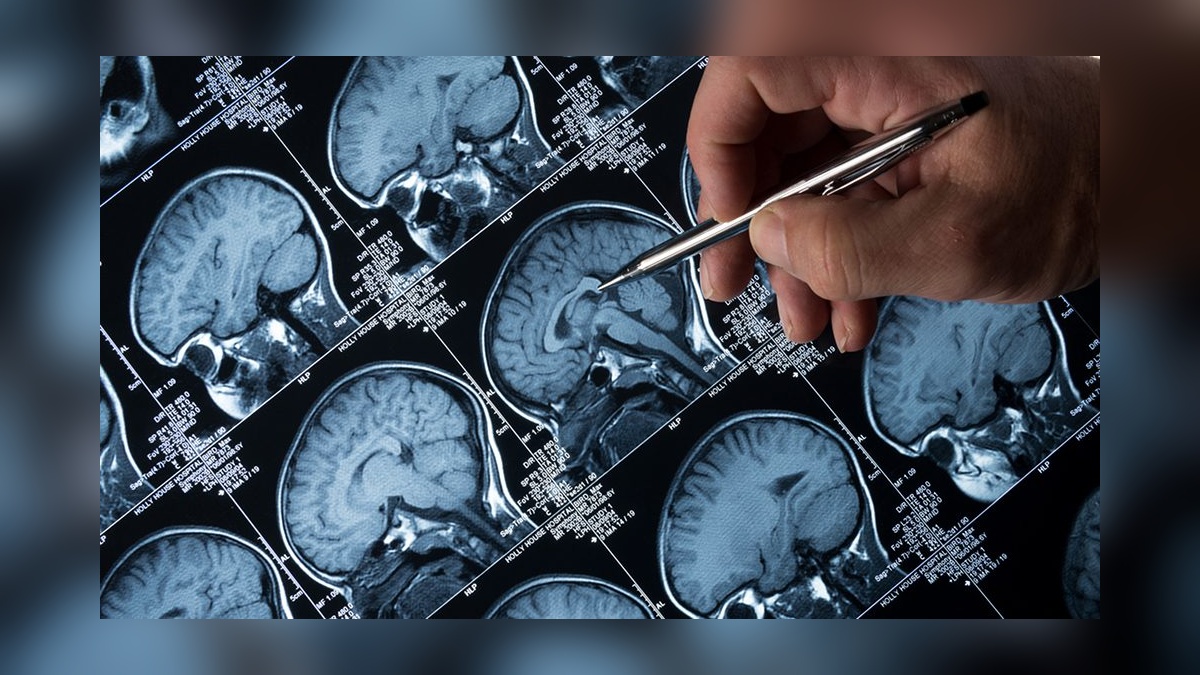 Harvard çalışması: Beyindeki lityum seviyesi Alzheimer'ı etkiliyor