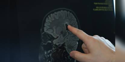 Serebral Palsi Tedavisinde Yeni Cerrahi Yöntem: Yaşam Kalitesi Dönüşüyor